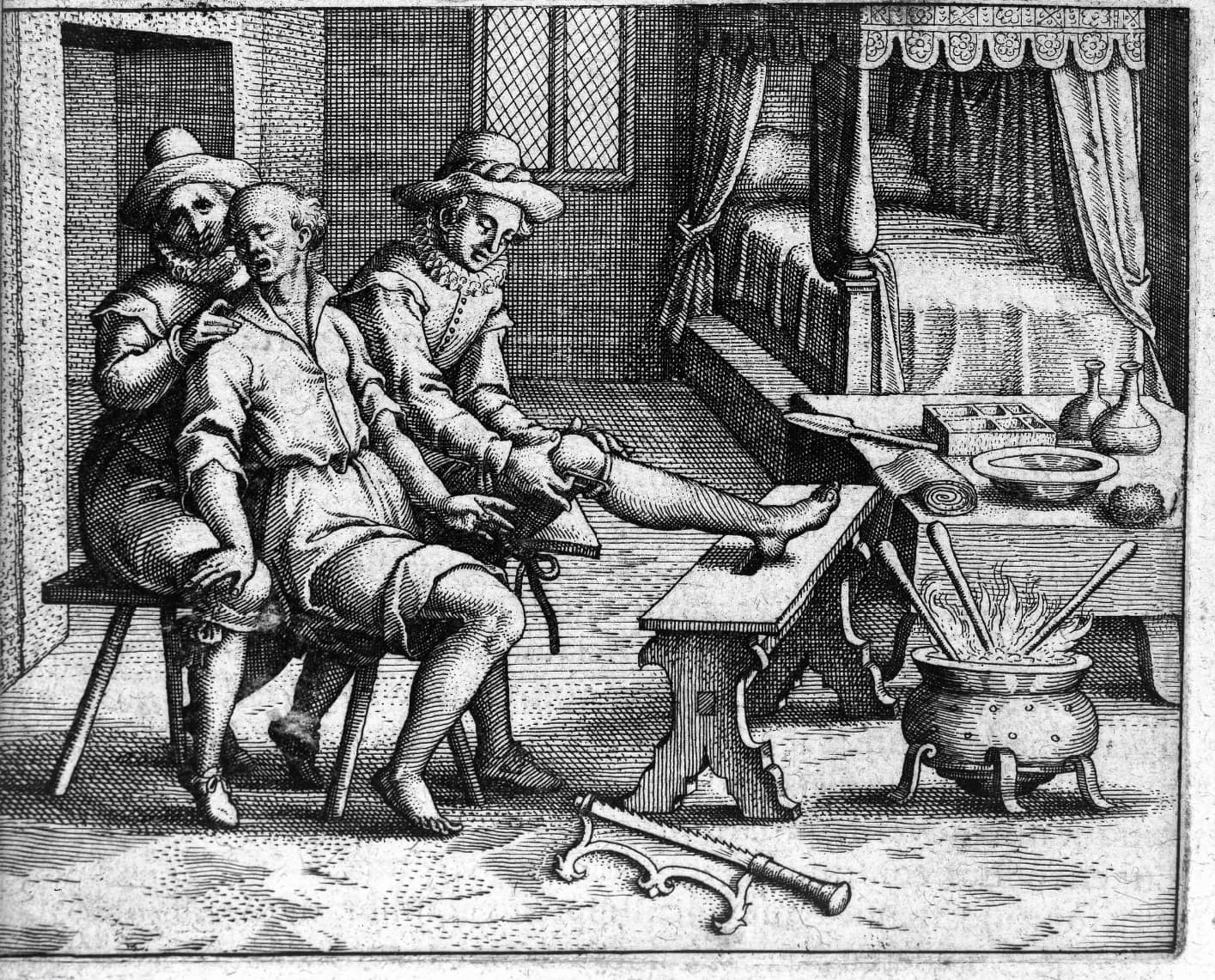 A drawing of a man preparing to have a leg amputated. He is looking away from the leg while another man is tying it off below the knee. There is a large saw on the ground beside them.